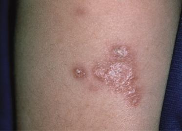 ataxia telangiectasia skin