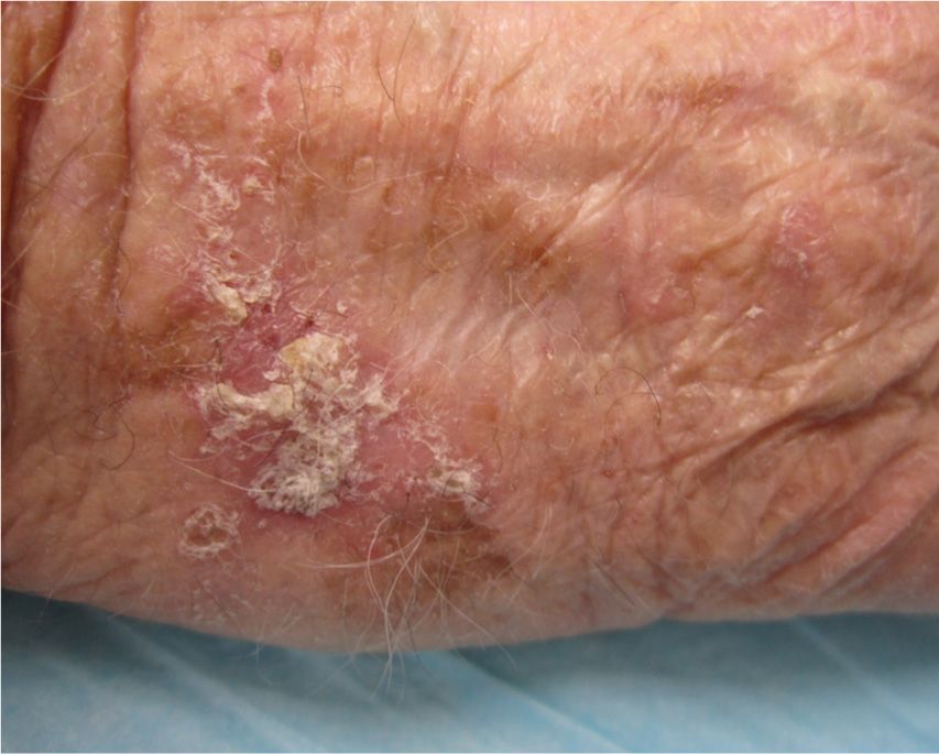 Precancerous and Nonmelanoma Skin Cancers | Plastic ...