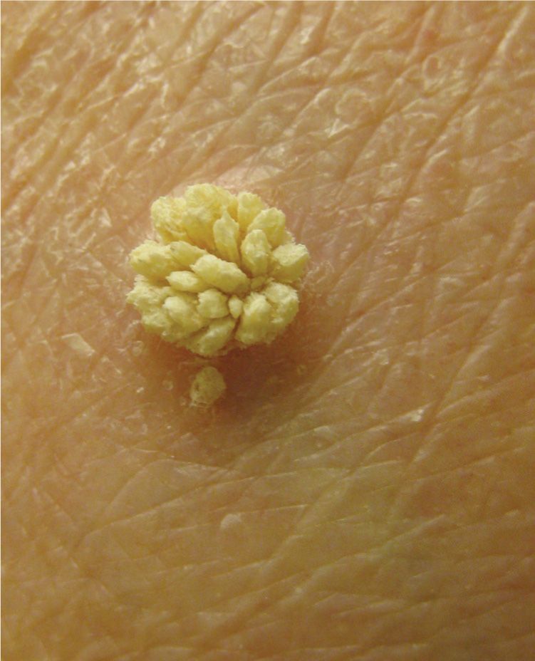 filiform wart scalp