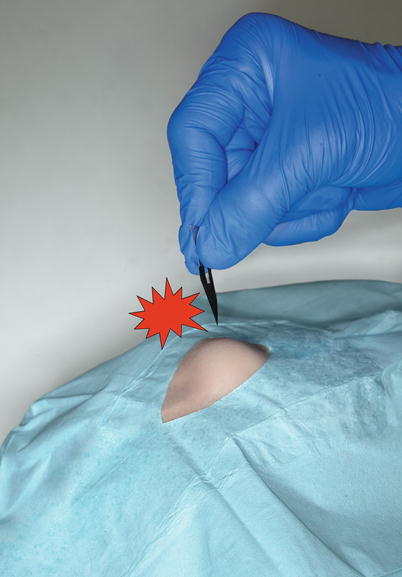 Incision And Drainage Abscesses Acne And Milia Plastic Surgery Key