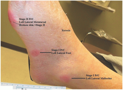 pressure ulcer stage 1 foot