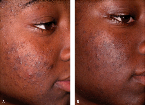 Topical Retinoids In Ethnic Skin | Plastic Surgery Key