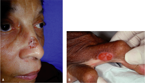 Surgical Treatment of Skin Cancers in Darker Racial Ethnic