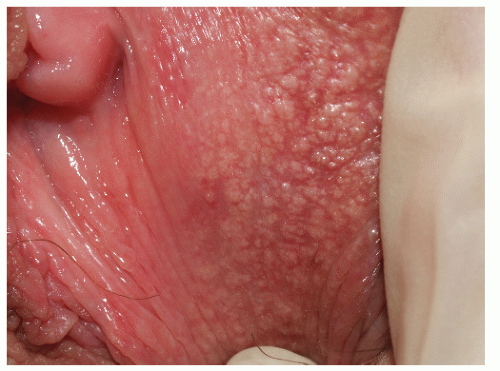 Fordyce Spots On Labia