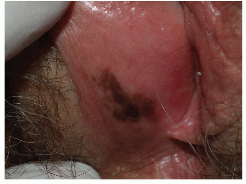 vulvar melanosis