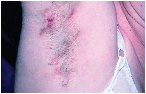 Hidradenitis Suppurativa Scars Reference Pictures