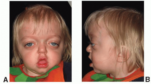 Craniosynostosis Syndromes | Plastic Surgery Key