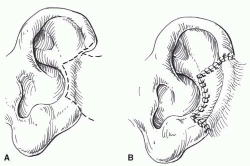 predicción Limpia el cuarto Anguila Ear Reconstruction | Plastic Surgery Key