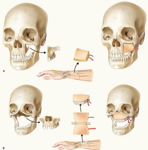 Orbital Reconstruction For Orbit Orbital Floor Fracture