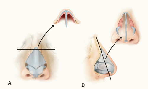 Rhinoplasty | Plastic Surgery Key