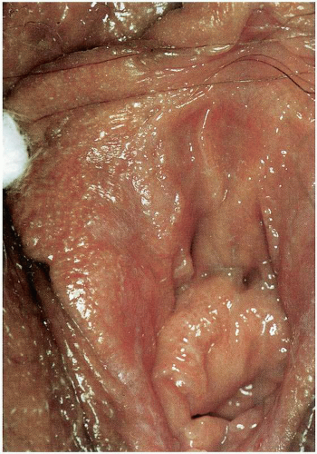 vulvar condyloma