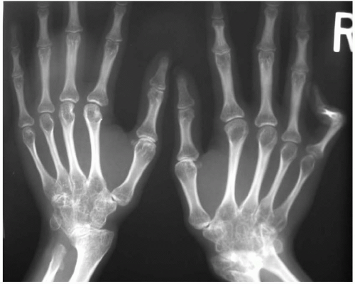 Rheumatoid Arthritis | Plastic Surgery Key
