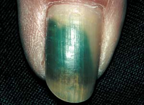 Subungual ectopic hair. Longitudinal ridge of the nail with intense... |  Download Scientific Diagram