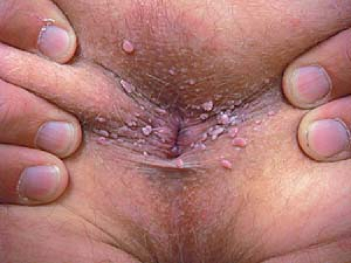 Anal Warts Look Like Anal Adult Videos