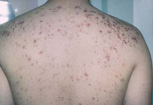 Acne and Related Disorders | Plastic Surgery Key