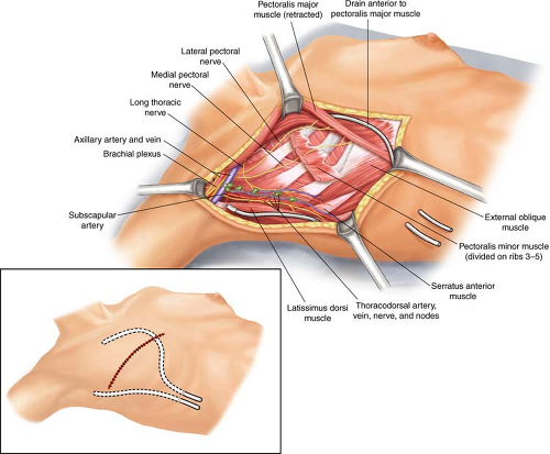 thoracodorsal nerve axillary dissection