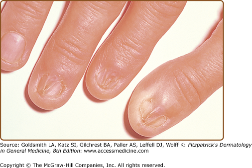 Discover more than 158 lichen planus nails symptoms super hot