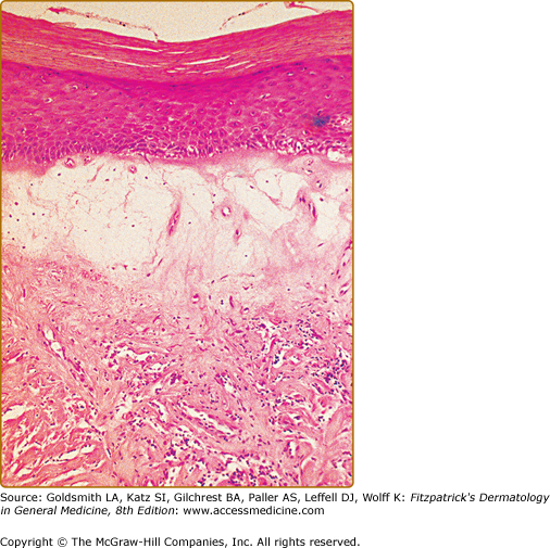 Lichen Sclerosus | Plastic Surgery Key