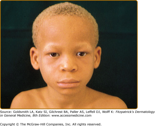Oculocutaneous Albinism Types