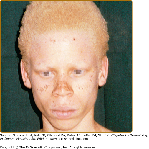Albinism And Other Genetic Disorders Of Pigmentation Plastic Surgery Key
