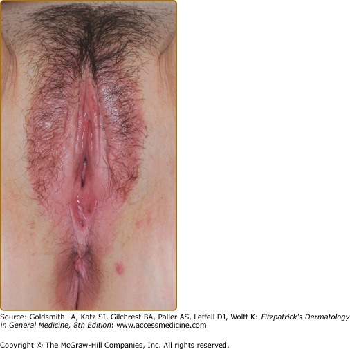 Depigmentation's Disorders Of The Vulva, Clinical Management