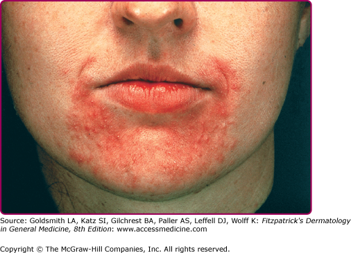 Typical perioral dermatitis. 