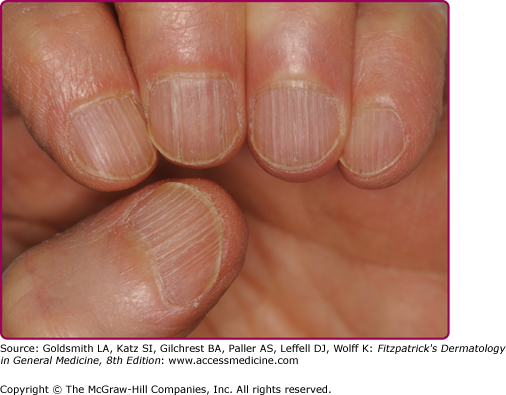 Figure 4 from Hair, nail, and pigment changes in major systemic disease. |  Semantic Scholar