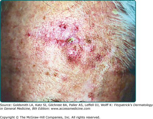Squamous Cell Carcinoma | Plastic Surgery Key