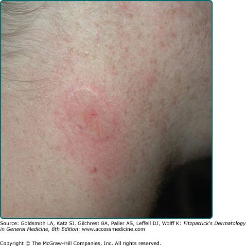 Basal Cell Carcinoma Scar Pictures Wildcard Reining 