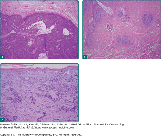morpheaform basal cell carcinoma histology