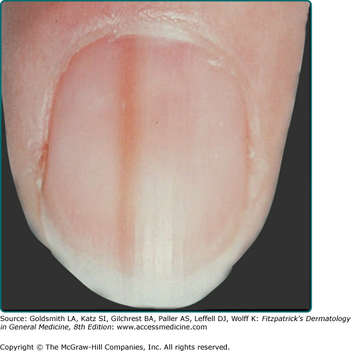 Lesion on the Nails | SpringerLink