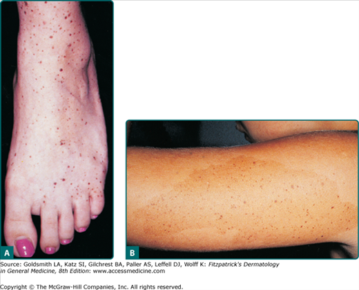 Dermatofibroma on leg in 37-year-old Black woman, demonstrating lack of