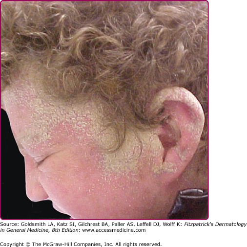 Hair loss  Atlantic Dermatology  Laser