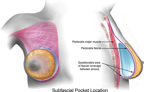 8: Implant Pocket Locations