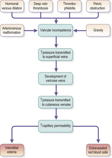 Pathophysiology of edema in patients with chronic venous insufficiency -  Servier - PhlebolymphologyServier – Phlebolymphology