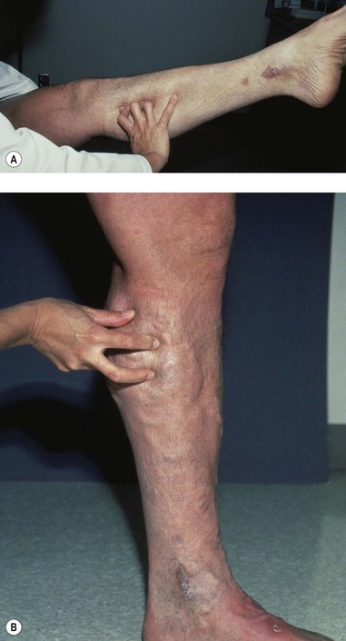 Noninvasive Examination of the Patient Before Sclerotherapy