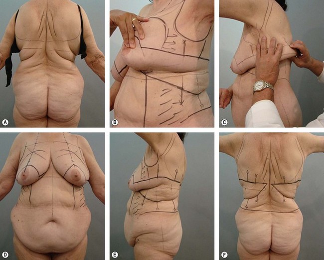 Liposuction of upper back/bra rolls