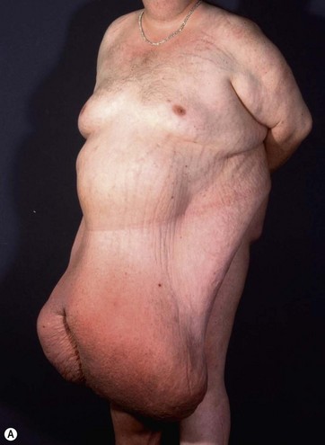 Frontal view of patient 2 (type IB) with a large pannus lifted up by