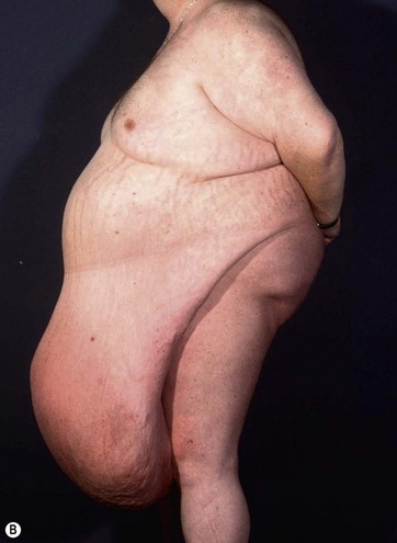 Frontal view of patient 2 (type IB) with a large pannus lifted up