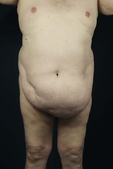 Frontal view of patient 2 (type IB) with a large pannus lifted up