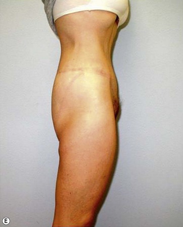 Short vertical scar medial thigh lift
