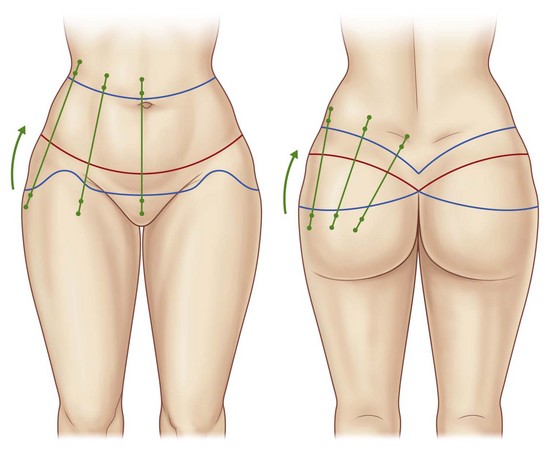 St Louis Flank and Hip Liposuction Procedure