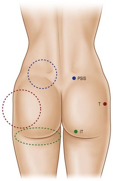 Postgluteal definition and torso contouring.