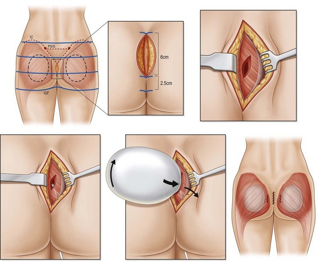 Gluteal Aesthetic Unit Classification