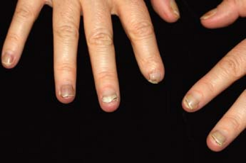 Common Disorders of the Nail Apparatus | Plastic Surgery Key