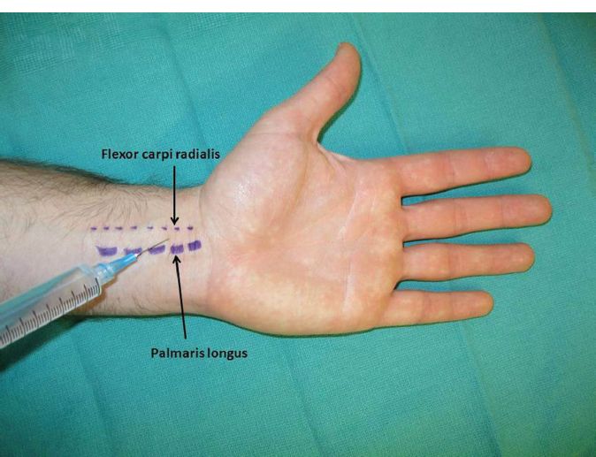 Ulnar Nerve Block Ultrasound