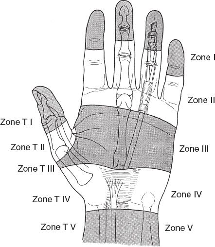 Thumb Flexor Tendon Zones