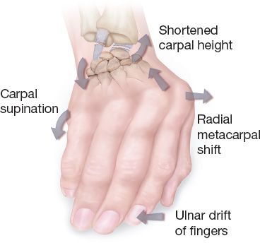 Rheumatoid Arthritis, Osteoarthritis, and Dupuytren’s Contracture ...