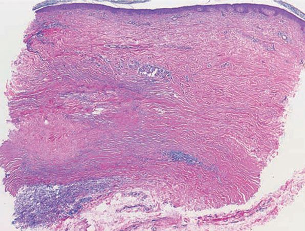 Necrobiosis Lipoidica Histology