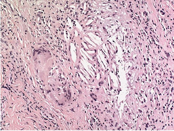 Keratin Granuloma (inflamed or ruptured cyst, inflamed or ruptured